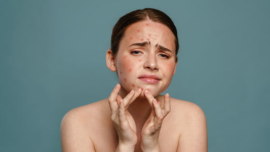 The best vitamins for combating acne and eczema